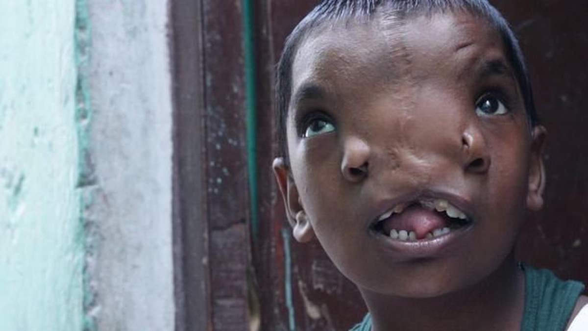 В Индии прооперировали девочку, родившуюся с хоботом: ее считают божеством