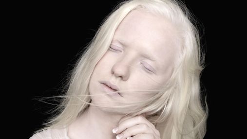 Коли білий – не колір, а його відсутність: що треба знати про альбінізм