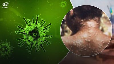 Світом шириться новий вид епідемії – віспа мавп: вірус з Африки вже дістався до Європи